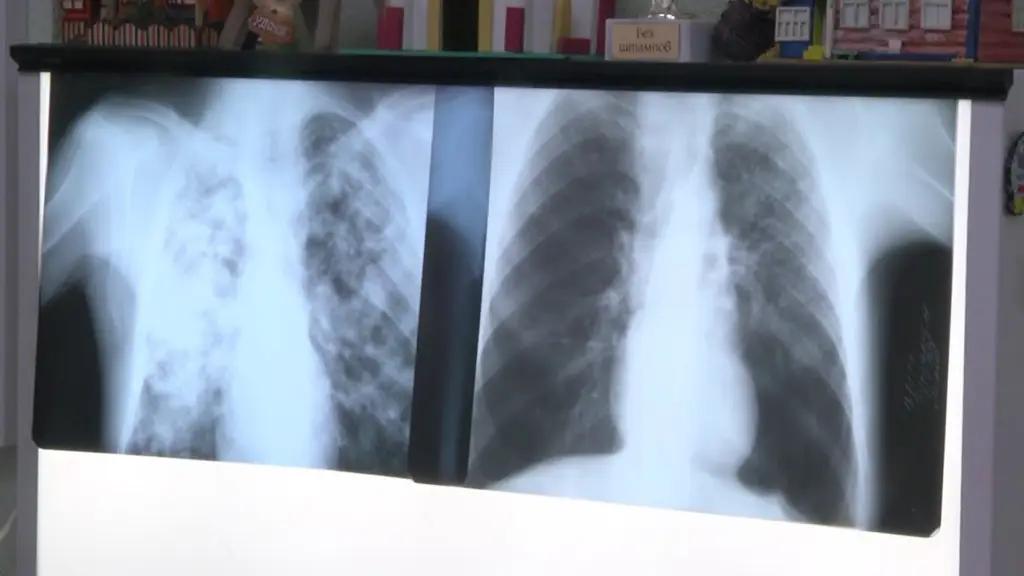 Кабмин хочет направить 1.2 млрд сомов на борьбу с туберкулезом