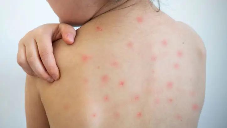 Жыл башынан бери кызамык менен дээрлик 13,5 миң адам ооруду