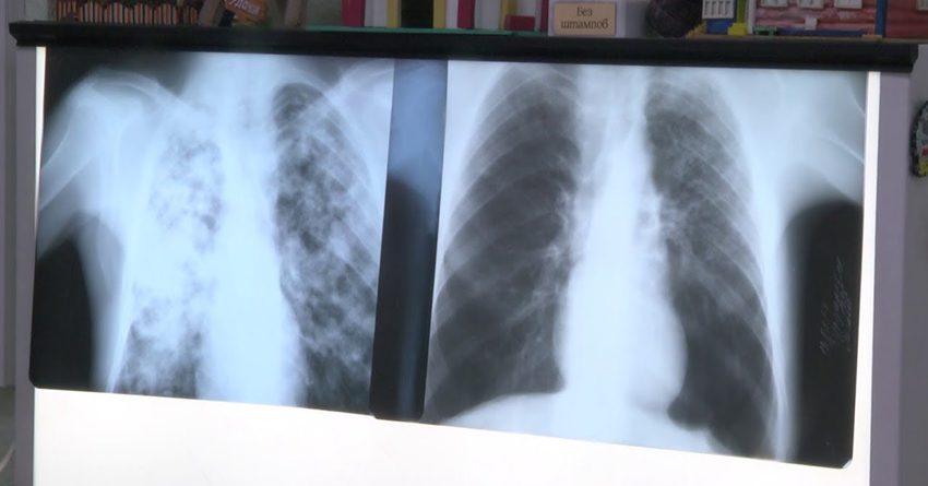 Кабмин хочет направить 1.2 млрд сомов на борьбу с туберкулезом